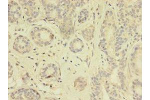 Immunohistochemistry of paraffin-embedded human breast cancer using ABIN7172114 at dilution of 1:100