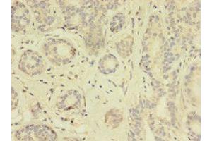 Immunohistochemistry of paraffin-embedded human breast cancer using ABIN7172114 at dilution of 1:100 (TK1 anticorps  (AA 2-234))