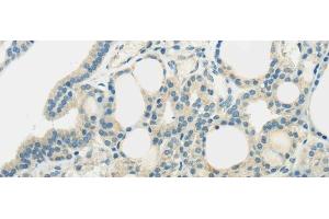 Immunohistochemistry of paraffin-embedded Human thyroid cancer using SLC7A11 Polyclonal Antibody at dilution of 1/35 (SLC7A11 anticorps)