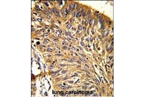 Formalin-fixed and paraffin-embedded human lung carcinoma reacted with PRDX3 Antibody (N-term), which was peroxidase-conjugated to the secondary antibody, followed by DAB staining.