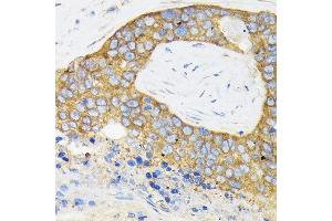 Immunohistochemistry of paraffin-embedded human esophageal cancer using RPS3 Rabbit pAb (ABIN3023342, ABIN3023343, ABIN3023344 and ABIN6219623) at dilution of 1:100 (40x lens). (RPS3 anticorps  (AA 1-243))