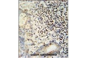 ESRP1 antibody (N-term) (ABIN652121 and ABIN2840556) immunohistochemistry analysis in formalin fixed and paraffin embedded human colon carcinoma followed by peroxidase conjugation of the secondary antibody and DAB staining. (ESRP1 anticorps  (AA 182-211))