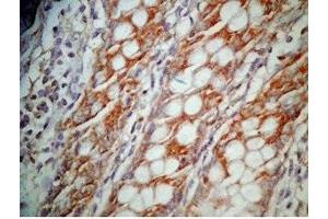 Human colon cancer tissue was stained by Rabbit Anti-GLP-1 (12-24) (Human) Antibody (GLP-1 anticorps  (AA 12-24))