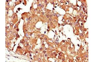 Immunohistochemistry of paraffin-embedded human breast cancer using ABIN7147342 at dilution of 1:100 (CRABP2 anticorps  (AA 1-138))