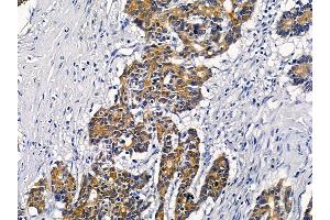 ABIN6258567 and ABIN6276236 at 1/100 staining human colorectal cancer by IHC-P. (VN1R2 anticorps  (Internal Region))