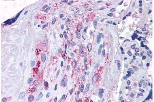 Human Placenta (formalin-fixed, paraffin-embedded) stained with ADAMTS5 antibody ABIN625839 at 14 ug/ml followed by biotinylated goat anti-rabbit IgG secondary antibody ABIN481713, alkaline phosphatase-streptavidin and chromogen.