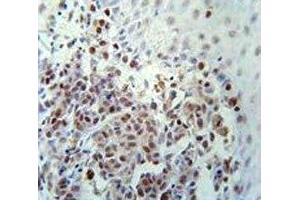 XRCC1 antibody immunohistochemistry analysis in formalin fixed and paraffin embedded human skin carcinoma.
