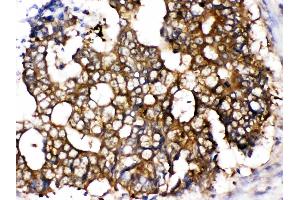 TCP1 epsilon was detected in paraffin-embedded sections of human intestinal cancer tissues using rabbit anti- TCP1 epsilon Antigen Affinity purified polyclonal antibody (Catalog # ) at 1 ?