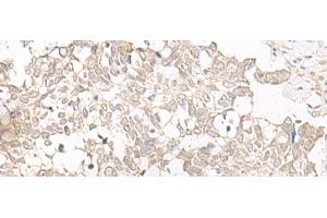 Immunohistochemistry of paraffin-embedded Human lung cancer tissue using ESPN Polyclonal Antibody at dilution of 1:25(x200) (Espin anticorps)