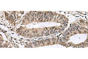 Immunohistochemistry of paraffin-embedded Human colorectal cancer tissue using TMX3 Polyclonal Antibody at dilution of 1:70(x200) (TMX3 anticorps)