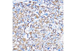 Immunohistochemistry of paraffin-embedded Human esophageal cancer using Cytokeratin 5 (Cytokeratin 5 (KRT5)) Rabbit pAb (ABIN3016404, ABIN3016405, ABIN3016406 and ABIN6219743) at dilution of 1:100 (40x lens).