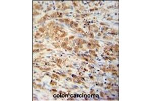 PRDX1 Antibody (Center) (ABIN389467 and ABIN2839531) immunohistochemistry analysis in formalin fixed and paraffin embedded human colon carcinoma followed by peroxidase conjugation of the secondary antibody and DAB staining. (Peroxiredoxin 1 anticorps  (AA 88-116))