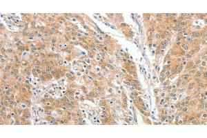Immunohistochemistry of paraffin-embedded Human gastric cancer using COL4A3BP Polyclonal Antibody at dilution of 1:60 (COL4A3BP anticorps)