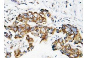 Anti-Superoxide Dismutase 1 antibody, IHC(P) IHC(P): Human Mammary Cancer Tissue (SOD1 anticorps  (C-Term))
