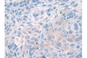 Detection of PYGB in Human Skin cancer Tissue using Polyclonal Antibody to Glycogen Phosphorylase, Brain (PYGB)