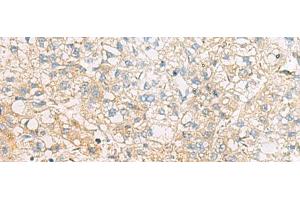 Immunohistochemistry of paraffin-embedded Human liver cancer tissue using EIF4E2 Polyclonal Antibody at dilution of 1:50(x200) (EIF4E2 anticorps)
