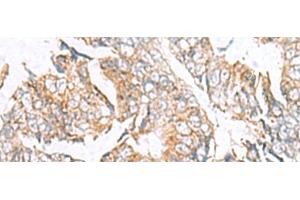 Immunohistochemistry of paraffin-embedded Human colorectal cancer tissue using GPC2 Polyclonal Antibody at dilution of 1:40(x200) (GPC2 anticorps)