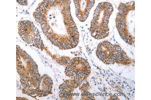 Immunohistochemistry of Human liver cancer using HCRTR1 Polyclonal Antibody at dilution of 1:70