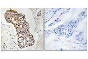 Immunohistochemistry analysis of paraffin-embedded human breast carcinoma tissue, using HSD11B1 antibody. (HSD11B1 anticorps  (N-Term))