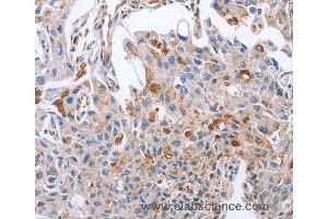 Immunohistochemistry of Human cervical cancer using NRG4 Polyclonal Antibody at dilution of 1:60 (Neuregulin 4 anticorps)