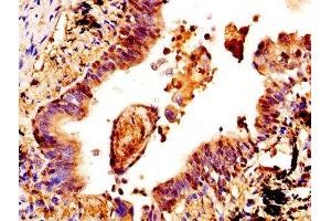 IHC image of ABIN7148983 diluted at 1:400 and staining in paraffin-embedded human lung cancer performed on a Leica BondTM system.