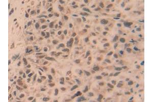 DAB staining on IHC-P; Samples: Human Lung cancer Tissue (TRAF5 anticorps  (AA 181-437))