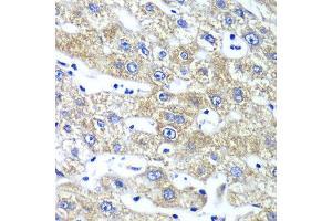 Immunohistochemistry of paraffin-embedded human liver injury using QARS antibody at dilution of 1:100 (x40 lens). (QARS anticorps)