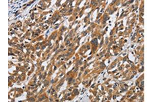 The image on the left is immunohistochemistry of paraffin-embedded Human esophagus cancer tissue using ABIN7190509(DSP Antibody) at dilution 1/40, on the right is treated with synthetic peptide.