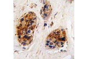 IHC analysis of FFPE human breast carcinoma tissue stained with VIM antibody (Vimentin anticorps  (AA 152-181))