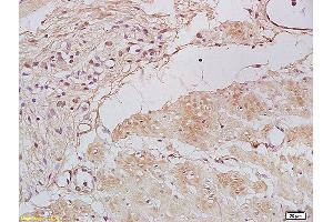 Formalin-fixed and paraffin embedded human gastric carcinoma labeled with Anti Tbx21/T-bet Polyclonal Antibody, Unconjugated (ABIN701395) at 1:200 followed by conjugation to the secondary antibody and DAB staining. (T-Bet anticorps)