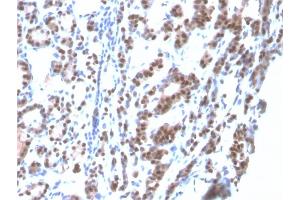 Formalin-fixed, paraffin-embedded human Thyroid stained with TTF-1 Mouse Recombinant Monoclonal Antibody (rNX2. (Recombinant NKX2-1 anticorps)