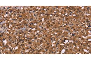 Immunohistochemistry of paraffin-embedded Human thyroid cancer using HDLBP Polyclonal Antibody at dilution of 1:50 (HDLBP anticorps)