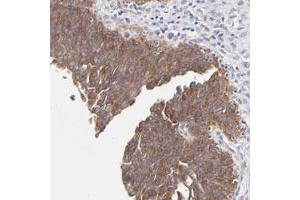Immunohistochemical staining of human urinary bladder with PPFIBP2 polyclonal antibody  shows strong cytoplasmic positivity in urothelial cells at 1:50-1:200 dilution. (PPFIBP2 anticorps)