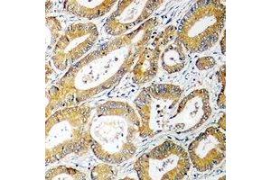 Immunohistochemical analysis of AGXT2L2 staining in human colon cancer formalin fixed paraffin embedded tissue section. (AGXT2L2 anticorps  (C-Term))