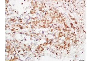 Formalin-fixed and paraffin embedded human lung carcinoma labeled with Rabbit Anti-B MyB Polyclonal Antibody, Unconjugated (ABIN760406) at 1:200 followed by conjugation to the secondary antibody and DAB staining