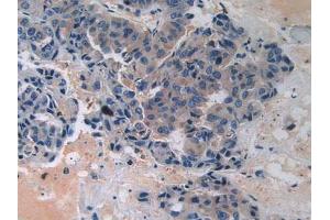 Detection of BARK in Human Breast Cancer Tissue using Polyclonal Antibody to Beta Adrenergic Receptor Kinase (BARK)