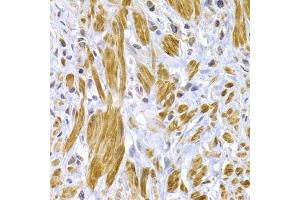 Immunohistochemistry of paraffin-embedded human gastric cancer using DSP antibody. (Desmoplakin anticorps)