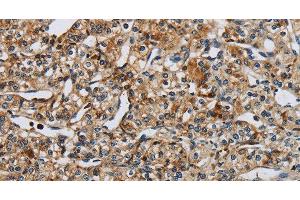 Immunohistochemistry of paraffin-embedded Human prostate cancer tissue using PERK Polyclonal Antibody at dilution 1:50 (PERK anticorps)