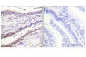 Immunohistochemical analysis of paraffin-embedded human lung carcinoma tissue using Cyclin A antibody. (Cyclin A1 anticorps)