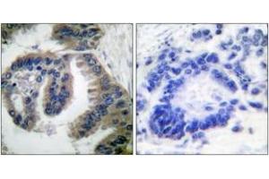 Immunohistochemistry analysis of paraffin-embedded human lung carcinoma tissue, using HSP40 Antibody. (DNAJB1 anticorps  (AA 271-320))