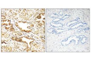 Immunohistochemistry analysis of paraffin-embedded human prostate carcinoma tissue, using CAMKK2 antibody. (CAMKK2 anticorps  (Internal Region))