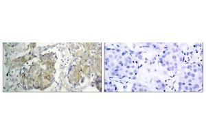 Immunohistochemical analysis of paraffin-embedded human breast carcinoma tissue, using V (VEGFR2/CD309 anticorps  (pTyr1214))