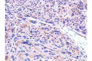 IHC-P Image CBR1 antibody [C2C3], C-term detects CBR1 protein at cytosol on human hepatoma by immunohistochemical analysis.