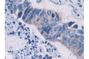 Detection of PCOLCE in Human Colorectal cancer Tissue using Polyclonal Antibody to Procollagen C-Endopeptidase Enhancer (PCOLCE)