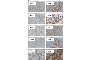 Immunostaining of EGFR ligands and co-expression with wtEGFR in mCRC specimensExpression of Amphiregulin, BTC, EGF, Epigen, and TGFα (A), and co-expression of wtEGFR, Amphiregulin, BTC, EGF, epigen, and TGFα in a particular patient (B) in formalin fixed paraffin embedded tumour sections stained immunohistochemically as described under methods and patients section. (Amphiregulin anticorps)