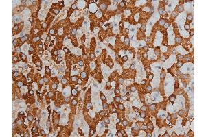 ABIN6267233 at 1/200 staining human liver cancer tissue sections by IHC-P.