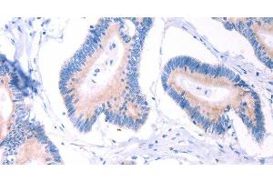Immunohistochemistry of paraffin-embedded Human colon cancer using AADAC Polyclonal Antibody at dilution of 1:30
