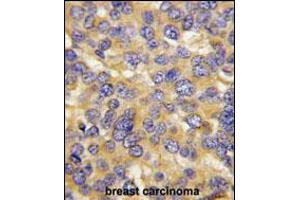 Formalin-fixed and paraffin-embedded human breast carcinoma tissue reacted with DKK3 Antibody (N-term), which was peroxidase-conjugated to the secondary antibody, followed by DAB staining. (DKK3 anticorps  (N-Term))