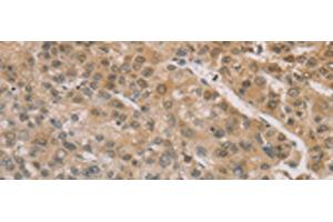 Immunohistochemistry of paraffin-embedded Human liver cancer tissue using ZIC2 Polyclonal Antibody at dilution of 1:100(x200) (ZIC2 anticorps)
