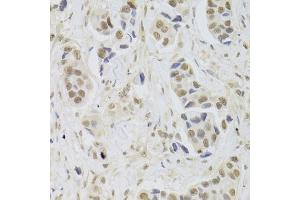 Immunohistochemistry of paraffin-embedded human breast cancer using UBE3C Antibody. (UBE3C anticorps)